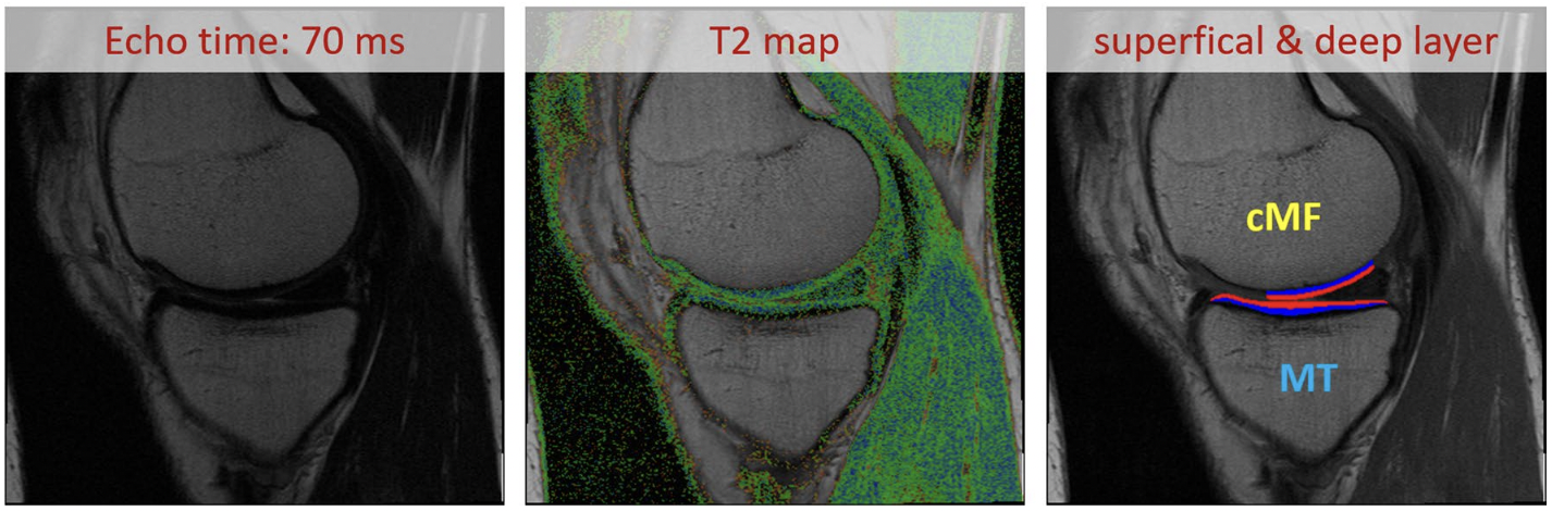 Evaluation of an automated laminar cartilage T2 relaxation time analysis method in an early osteoarthritis model